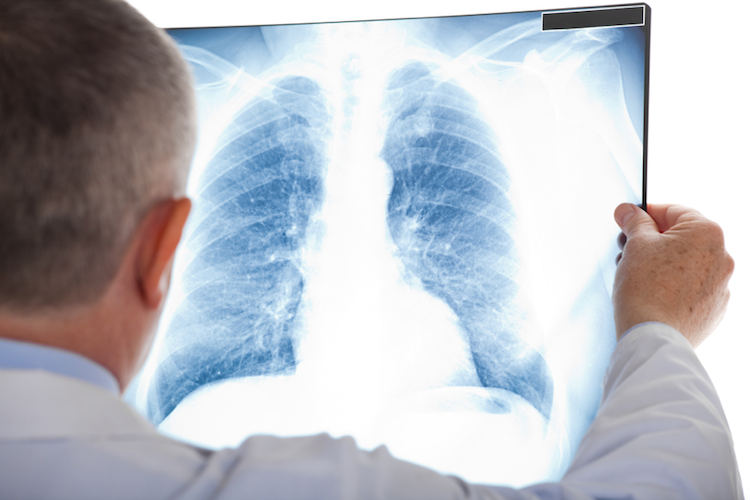 How Long Can You Live After Being Diagnosed With Lung Cancer?
